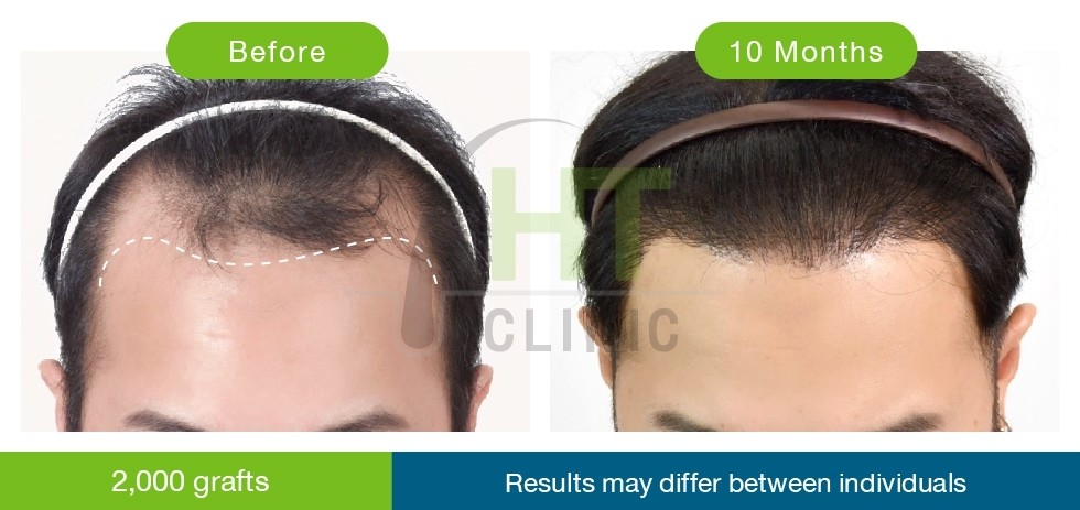 How do we make a natural hairline? - Hairtran Clinic