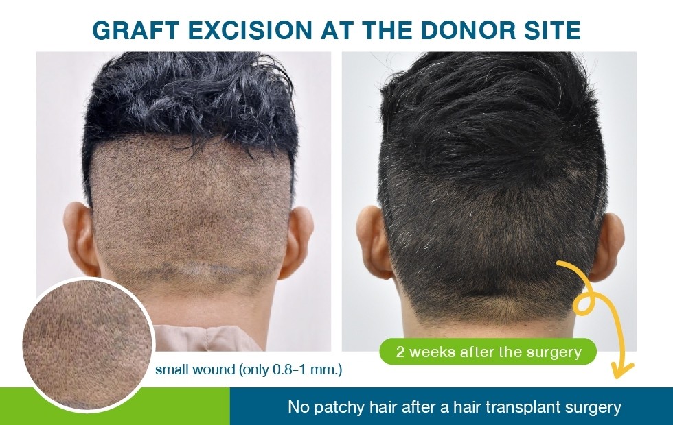 How long does a transplanted hair last? - Hairtran Clinic