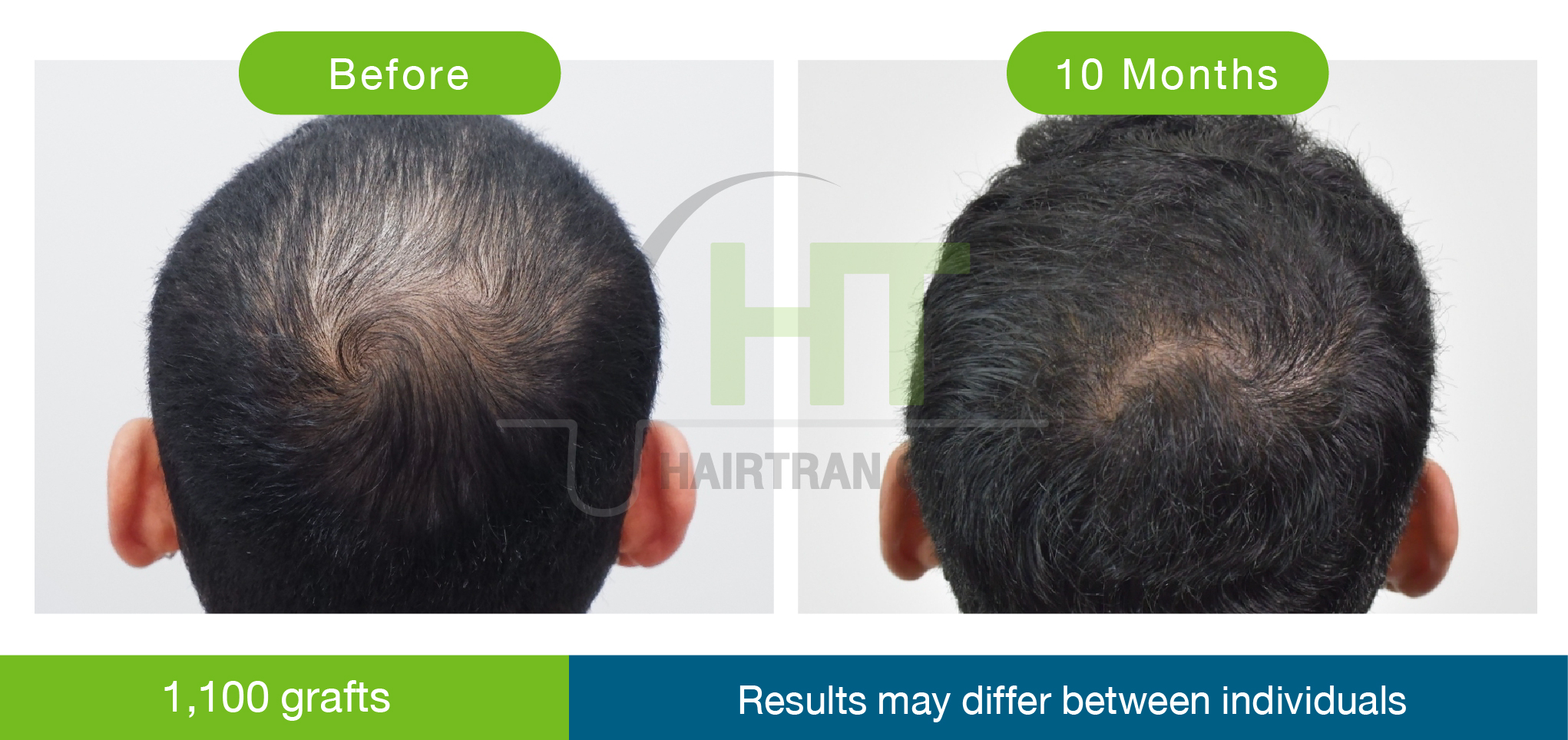 How much does hair transplant Thailand cost? - Hairtran Clinic