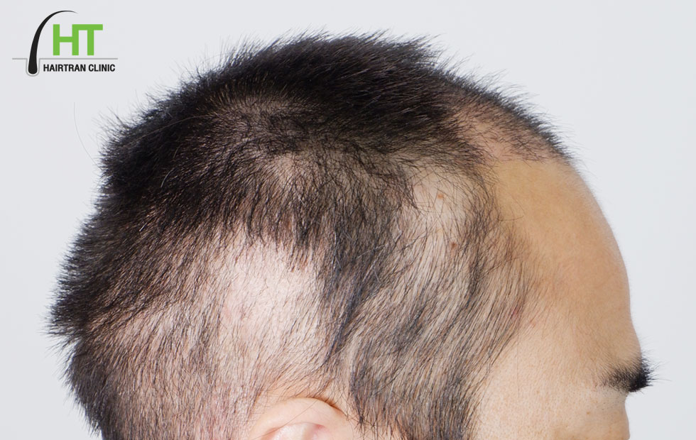 Overview about shock hair loss - Hairtran Clinic