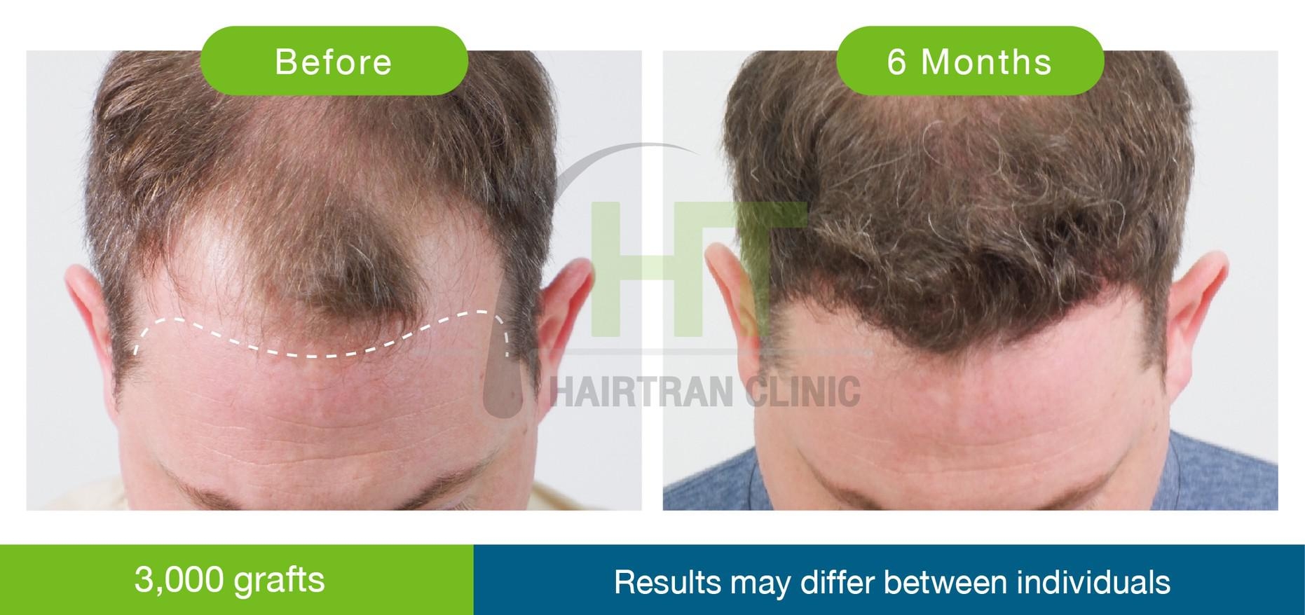 Taking hair growth medicine after a hair transplant - Hairtran Clinic