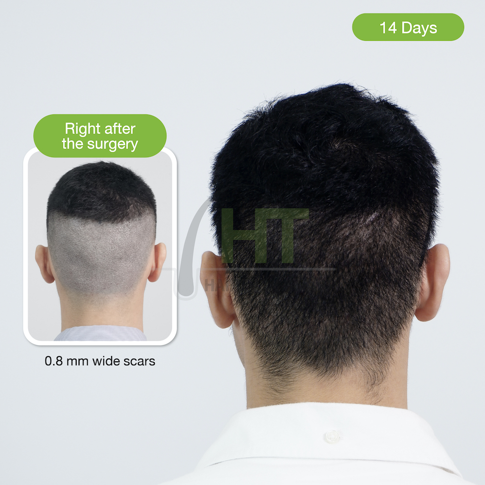 Why do some FUE hair transplant scars look worse than others? - Hairtran  Clinic