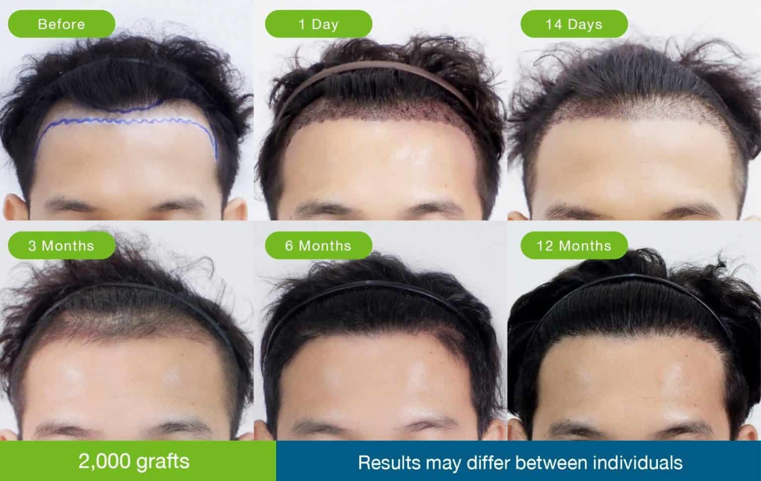 Hair transplant