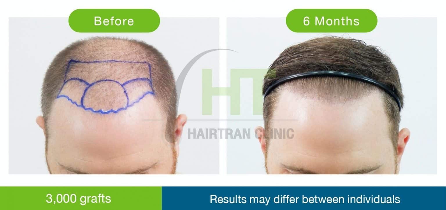 FUE Hair transplant bangkok (Thailand) Hairtran Clinic