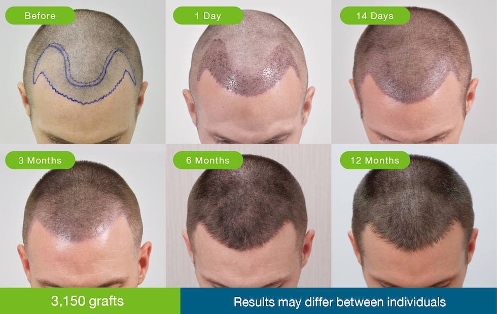 Aggregate 146+ cap after hair transplant latest